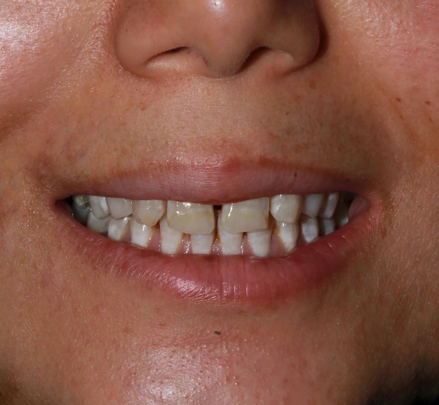 عکس قبل از درمان کامپوزیت ونیر و دندان های بد شکل و بدرنگ